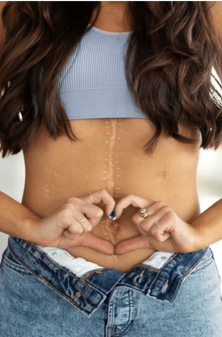 Cicatrização pós cirúrgica associada ao Óleo de Rosa Mosqueta&nbsp;Epilê