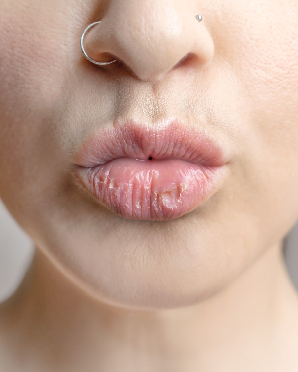 Lábios Rachados: 7 causas comuns e como recuperar a&nbsp;maciez