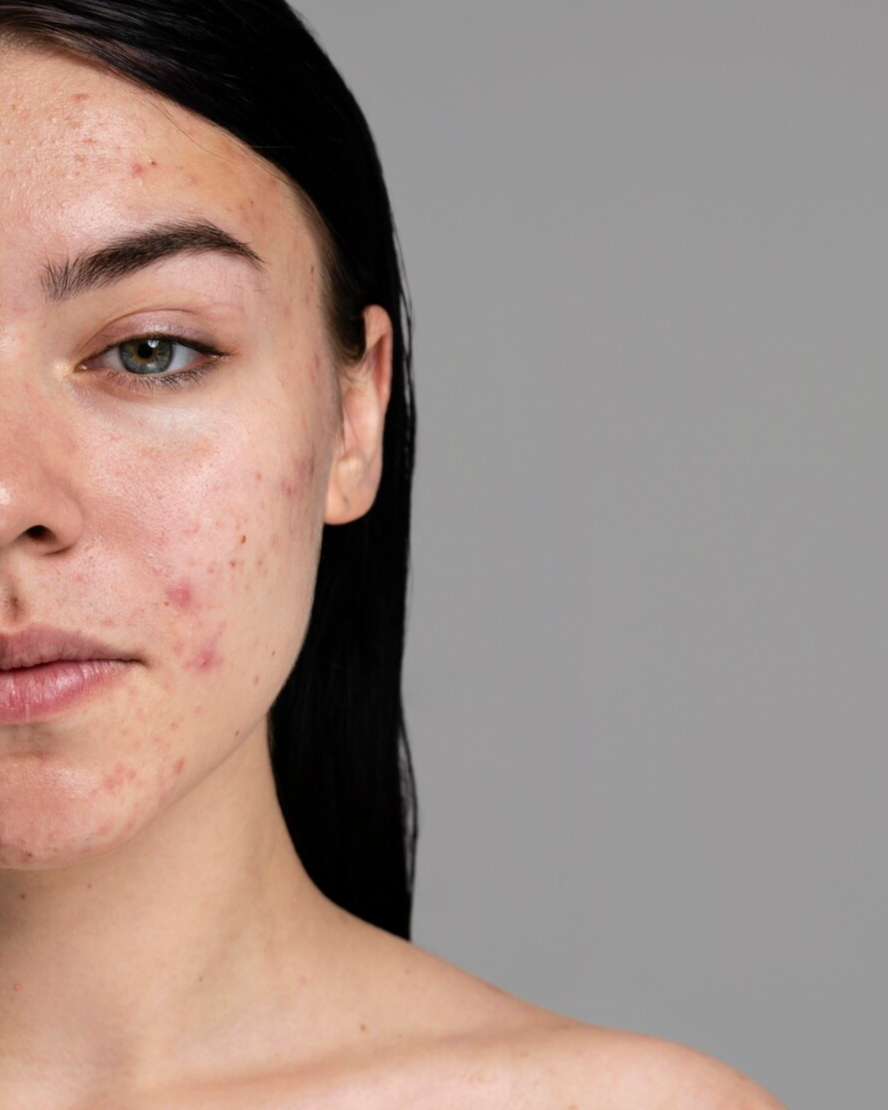 Manchas de acne e sol? Como a Rosa Mosqueta regenera sua pele&nbsp;naturalmente